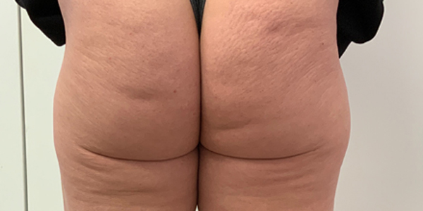 Heavy cellulite clearance thighs