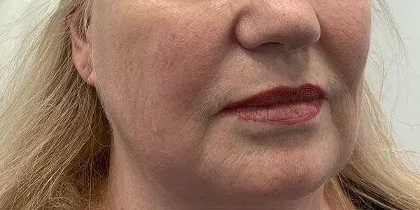 before face lift with pdo threads