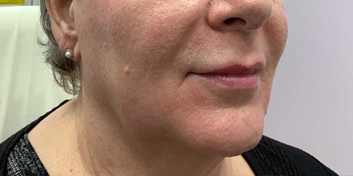 Close-up of a woman's face showing the left side before Bellafill fillers treatment at Albany Laser & Cosmetic Center, with visible skin texture and wrinkles.