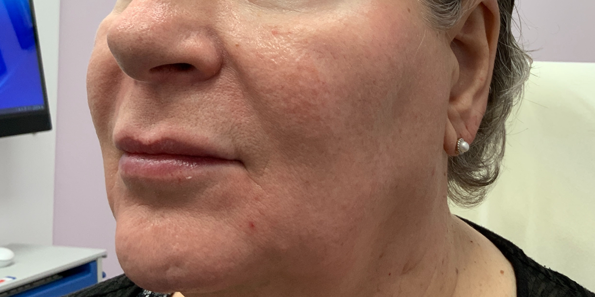 Close-up of a woman's face showing a front view before Bellafill fillers treatment at Albany Laser & Cosmetic Center, with noticeable lines and uneven skin texture.