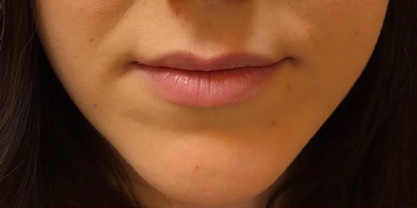 lip fillers before