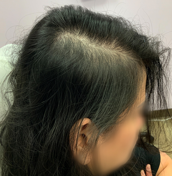 before prp hair loss injections edmonton