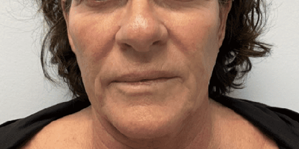 a picture of a female in her 60s before treatment at Albany Cosmetic and Laser Centre