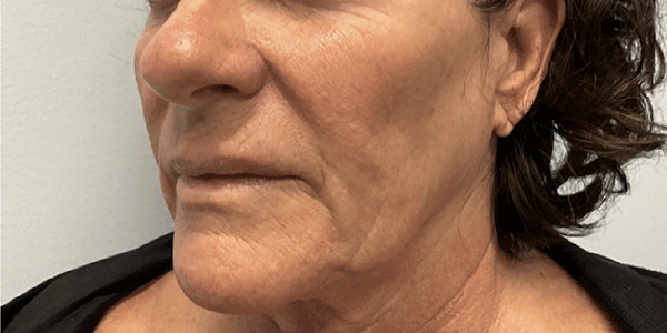 a picture of a female in her 60s before treatment at Albany Cosmetic and Laser Centre. Side view