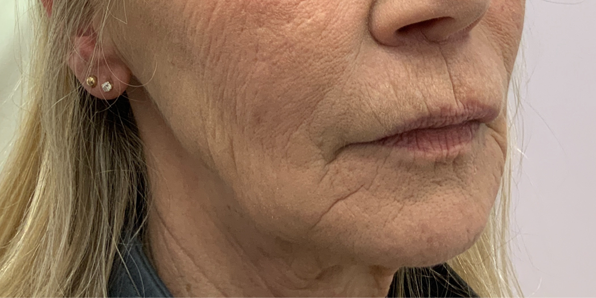 Close-up image of a woman's lower face before a cosmetic procedure at Albany Laser & Cosmetic Center, showing visible wrinkles and sagging skin around the mouth and jawline.