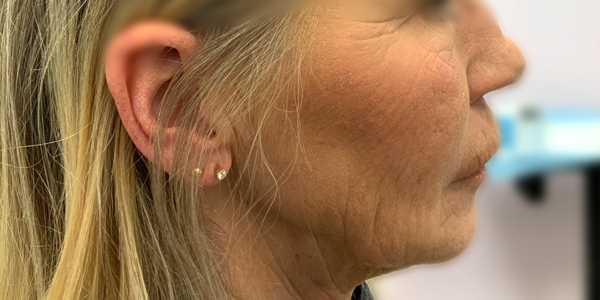 Close-up side profile of a woman's face before a cosmetic procedure at Albany Laser & Cosmetic Center, showing visible wrinkles and sagging skin around the jawline and cheek.