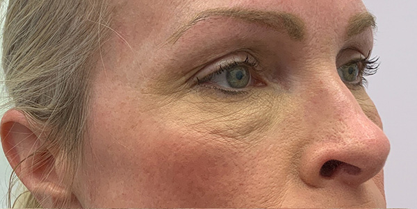 before under eye filler injections