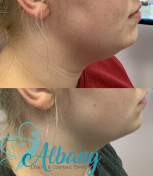 before and after belkyra