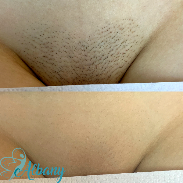 bikini hair removal Edmonton