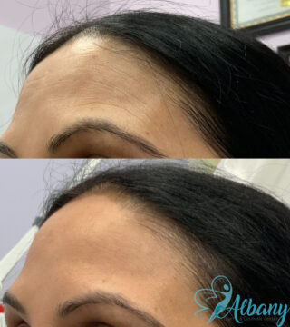botox results st. albert
