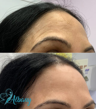 botox results edmonton