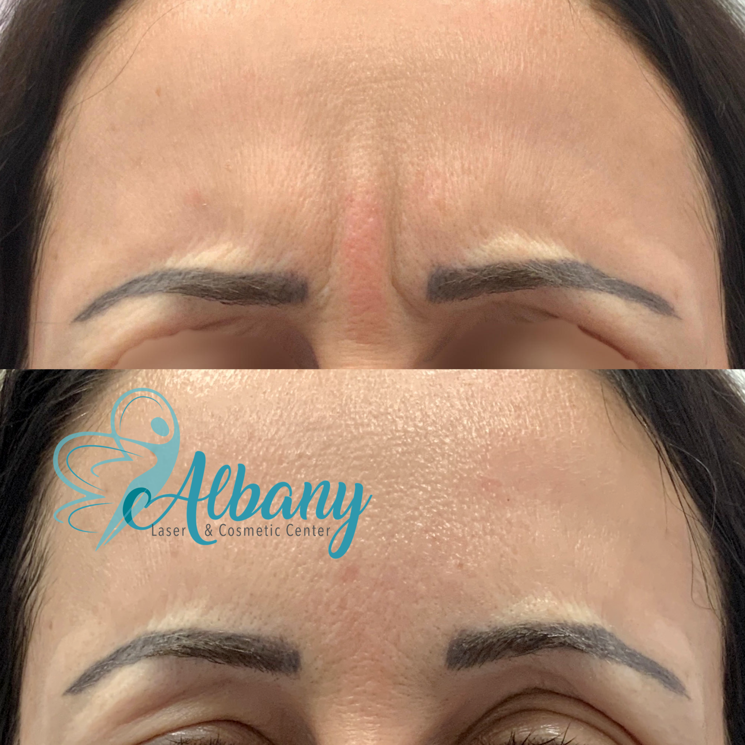 Before and after pictures of a patient's forehead showing significant reduction in frown lines and wrinkles after Botox treatment at Albany Cosmetic and Laser Centre in Edmonton.