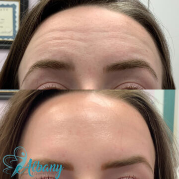 Close-up of a woman's forehead before and after Botox treatment, showing reduction in horizontal forehead lines