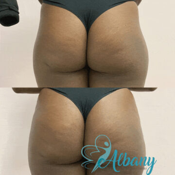 Before and after BBL results demonstrating increased volume and improved buttock shape in a woman wearing black underwear