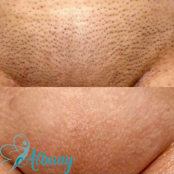 Before and after images of Brazilian laser hair removal on a woman, showing the transition from hair growth to smooth, hair-free skin in the bikini area.