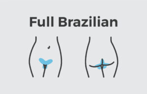 brazilian laser hair removal