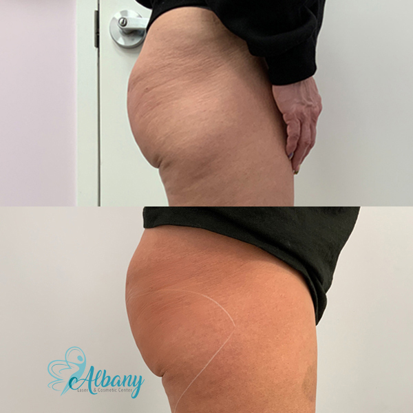before after cellulite treatment
