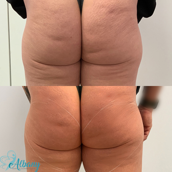 Endermologie: What to Know About the Cellulite Treatment