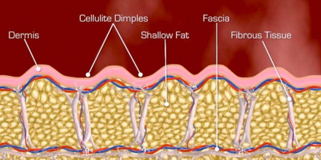 Information on dimpled skin formation