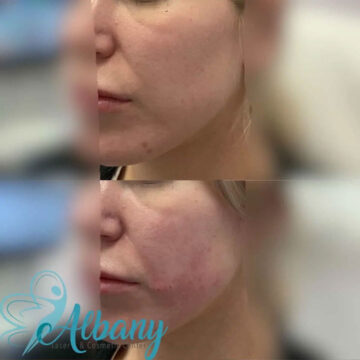 cheek augmentation results
