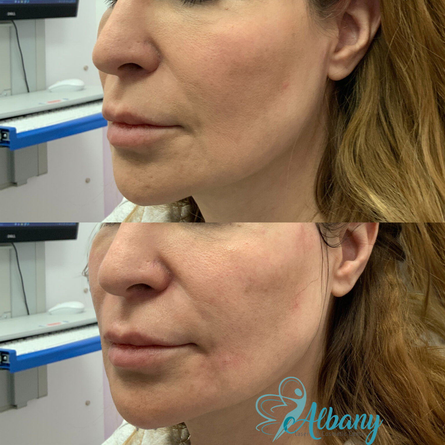 cheek fillers results edmonton