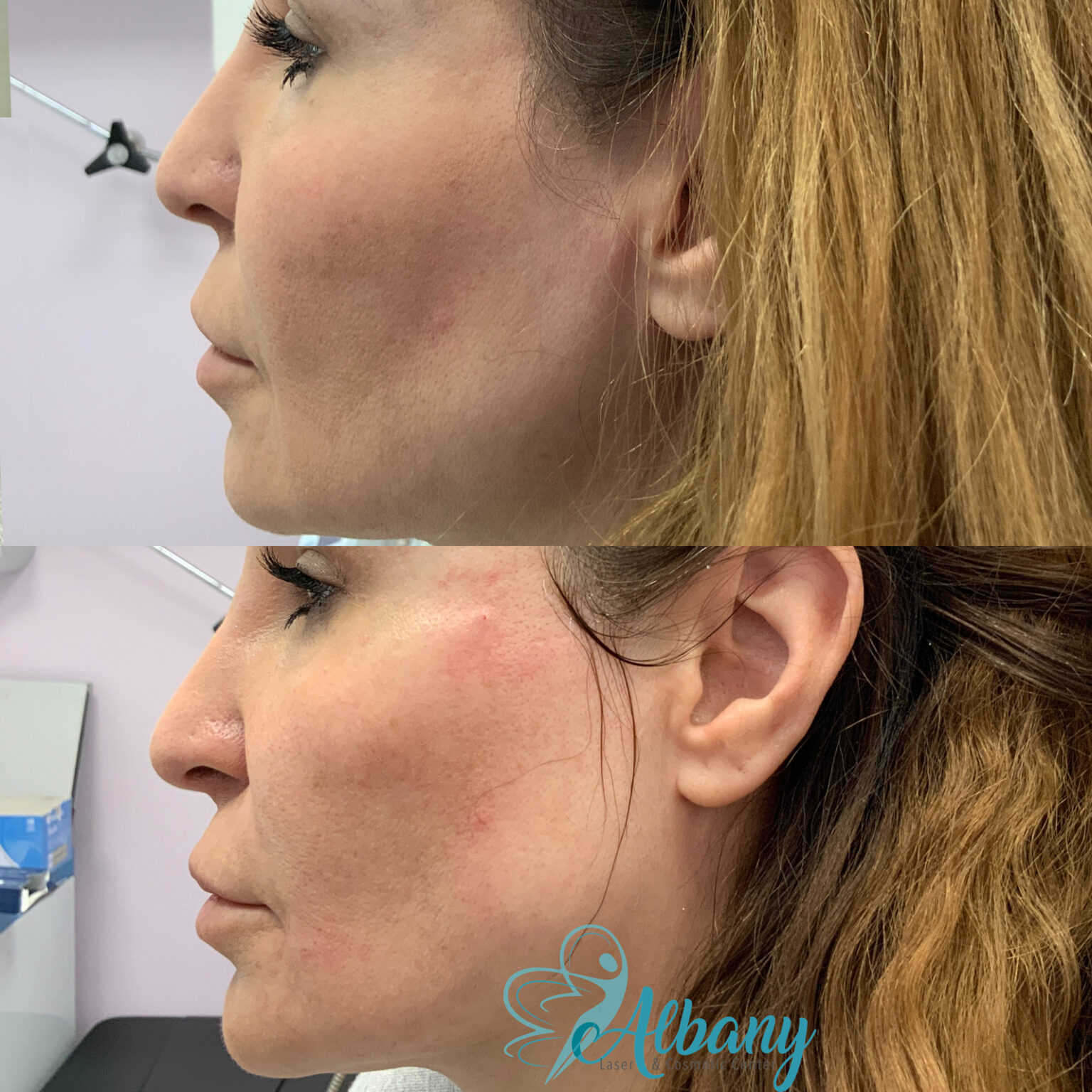 Cheek Augmentation With BellaFill | Albany cosmetic laser Centre