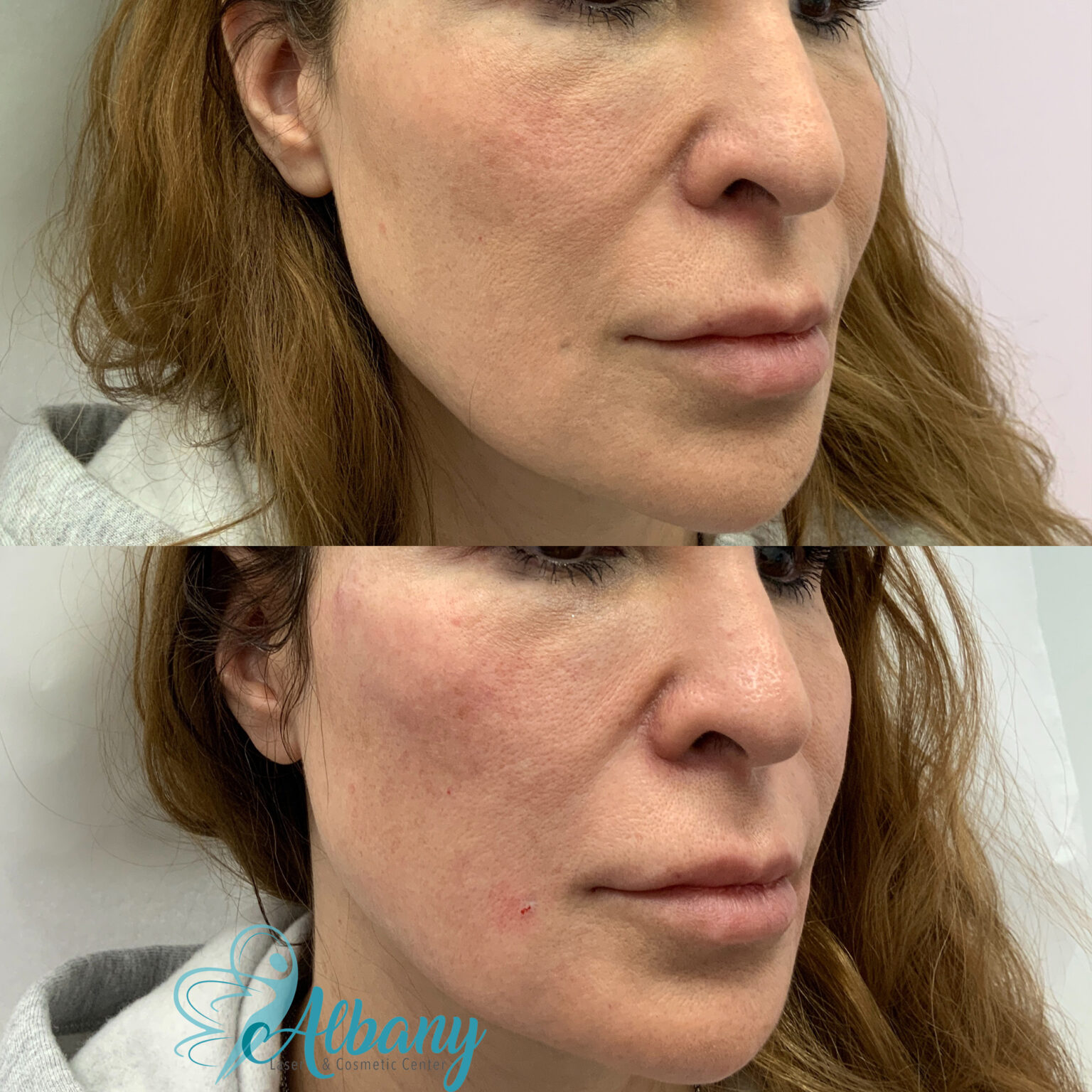 cheek injection results edmonton