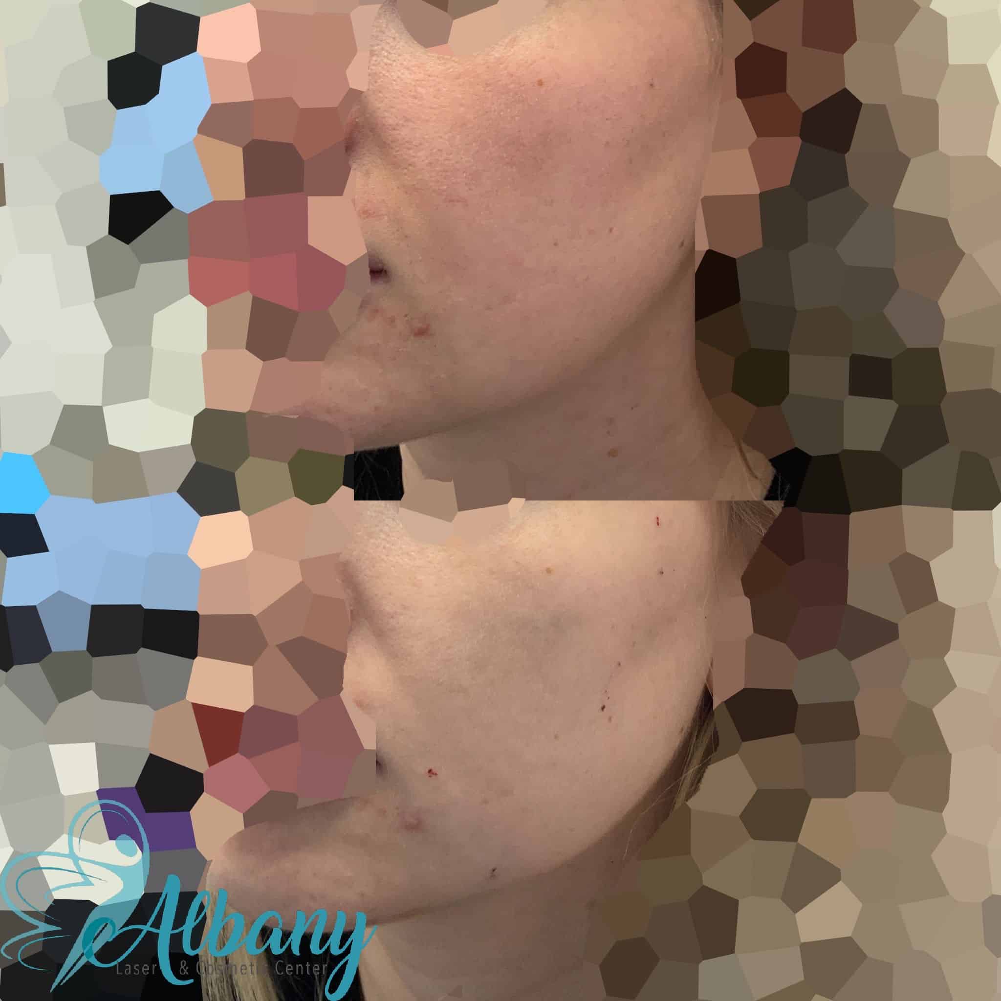 cheek fillers results