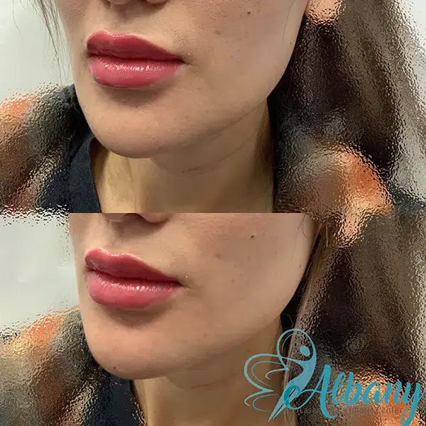 before and after chin augmentation Edmonton