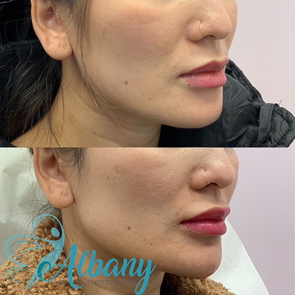 before and after chin injection Edmonton