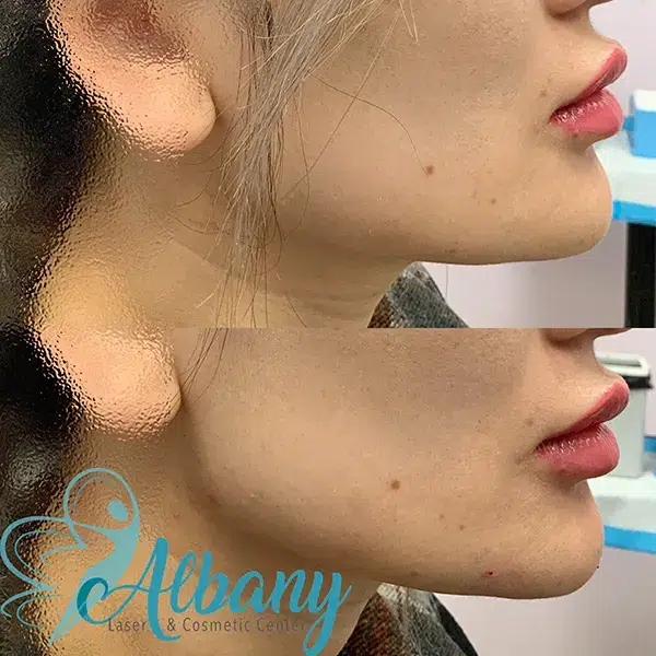 before and after chin fillers Edmonton