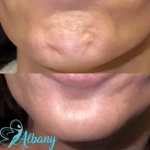 A picture that shows the improvement in chin dimple after Botox treatment in Edmonton