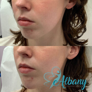 chin correction edmonton