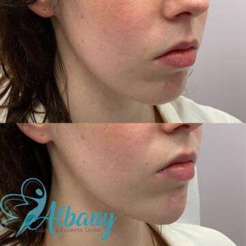 chin augmentation edmonton