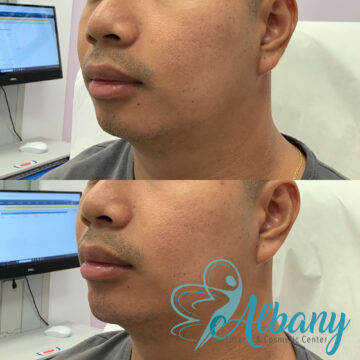 chin fillers before and after