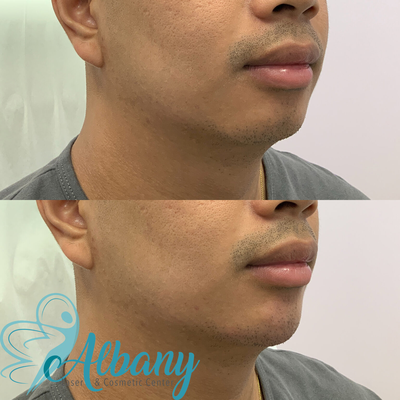 chin fillers results