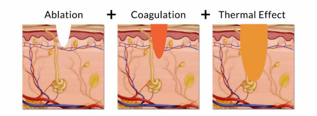 skin coagulation with laser