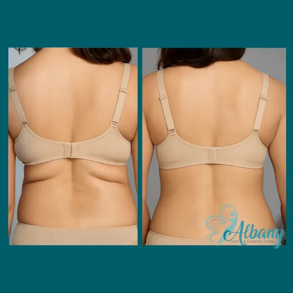 Before-and-after comparison of a woman’s back with a beige bra, illustrating CoolSculpting results. The left image shows prominent fat rolls under the bra line, while the right image reveals a firmer, slimmer back area with significantly less bulging