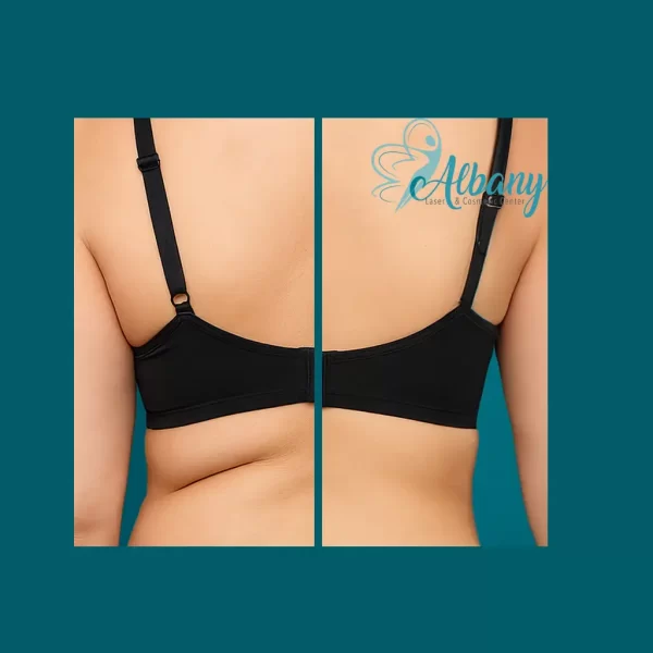 Before-and-after CoolSculpting results for love handles on a woman's lower back. The left image shows a wider waistline with visible fat accumulation, while the right image demonstrates a more contoured waist with smoother skin and reduced fat deposits.