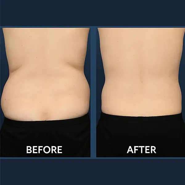Before-and-after comparison of a person’s lower back showing the results of CoolSculpting on love handles. The left image, labeled 'Before,' shows noticeable fat bulges on both sides of the waist. The right image, labeled 'After,' displays a more contoured and slimmer waistline. Both images are set against a dark blue background with 'COOLSCULPTING' written above and 'LOVE HANDLES' written below.