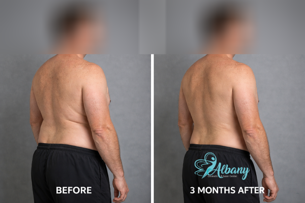 coolsculpting results at Albany Cosmetic and Laser Centre in Edmonton 3
