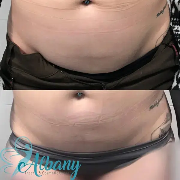 Before and after CoolSculpting treatment on the abdomen at Albany Cosmetic and Laser Centre, showing noticeable fat reduction and a more contoured midsection.