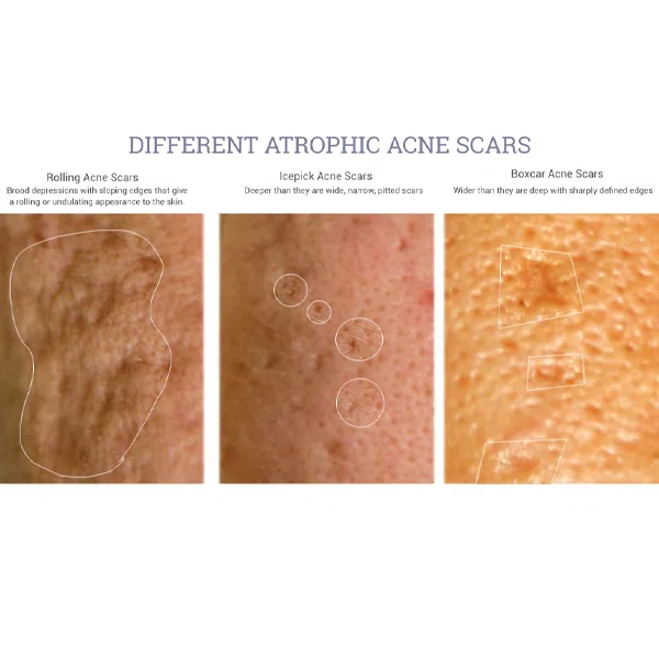 different types of atrophic acne scars