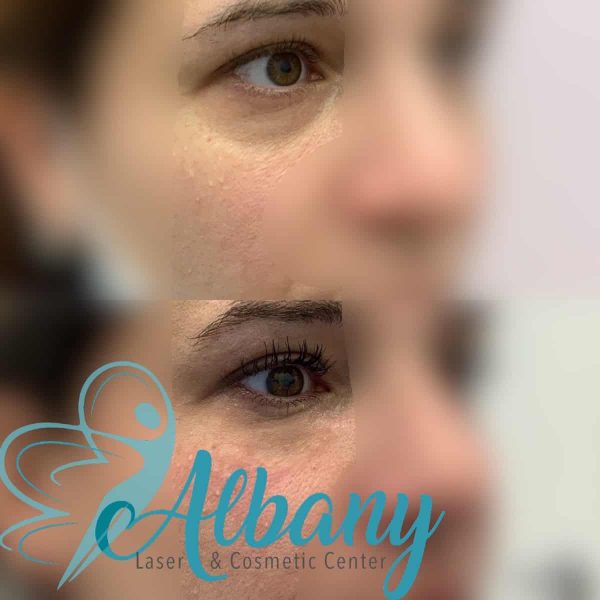 undereye fillers Edmonton