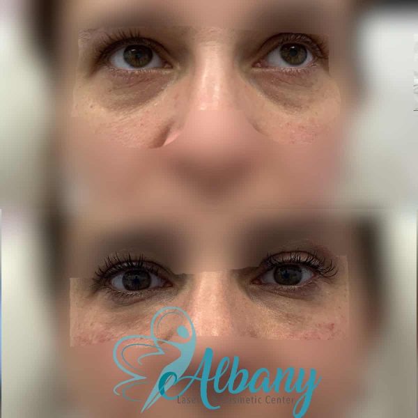 undereye fillers Edmonton