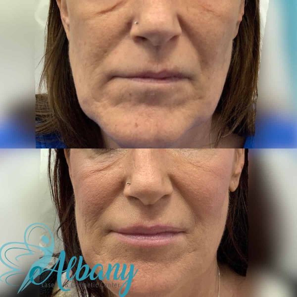 before and after liquid facelift