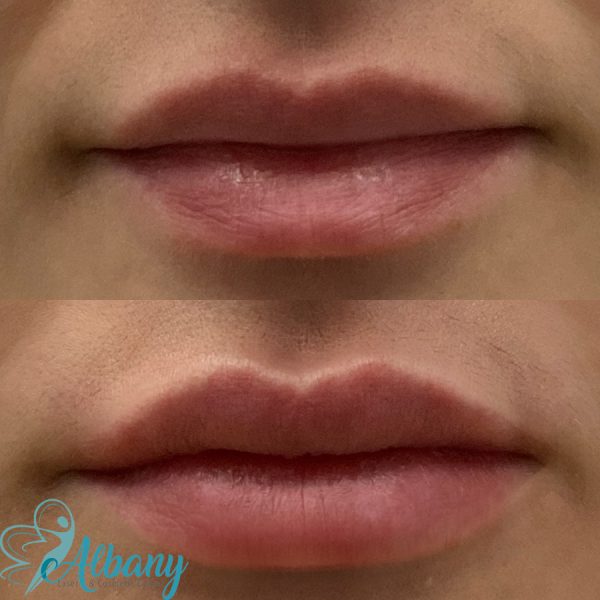 Lip injections results
