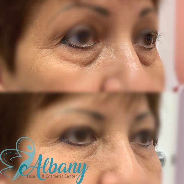 Under eye fillers edmonton