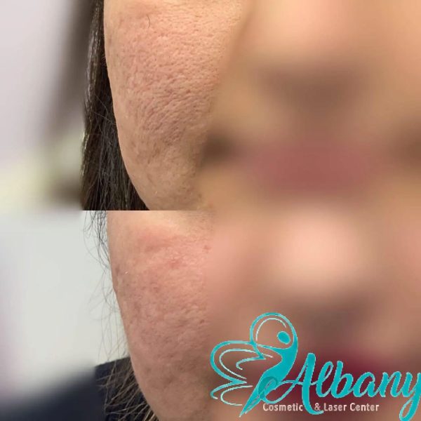 before and after enlarged pores treatment with laser