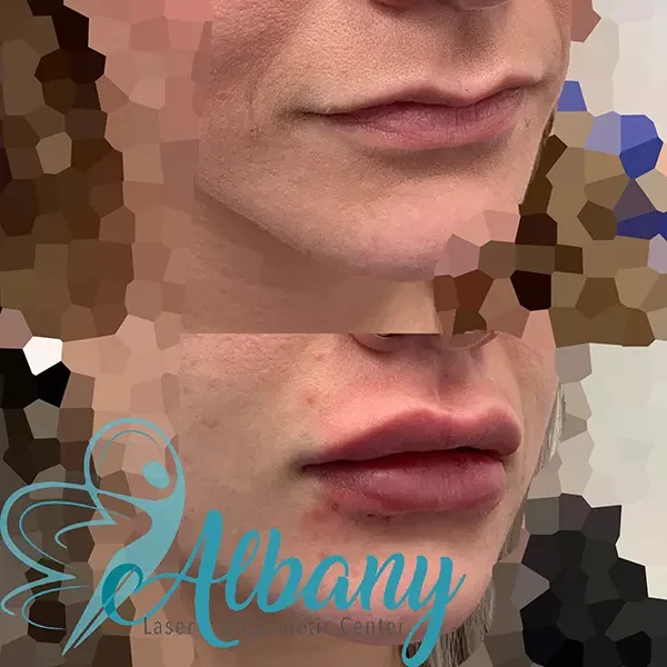 Juvederm Lip fillers results